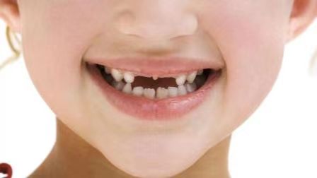 儿童换牙期7大注意事项